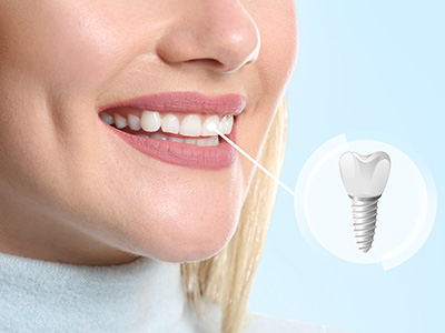 Lake Street Dental | Crowns  amp  Caps, Veneers and Oral Exams