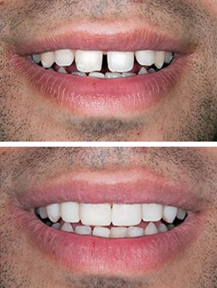 Lake Street Dental | Extractions, Night Guards and Cosmetic Dentistry