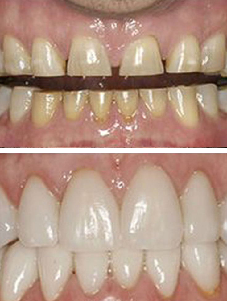 Lake Street Dental | Sleep Apnea, Dentures and Crowns  amp  Caps