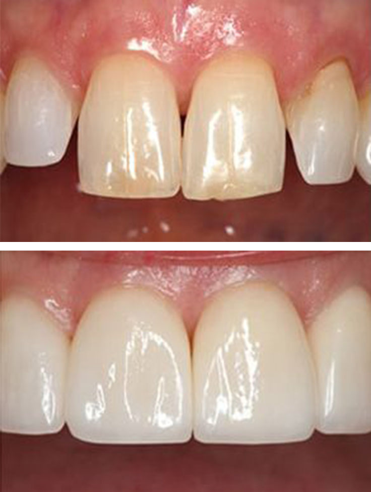 Lake Street Dental | Oral Exams, Invisalign reg  and Dental Fillings